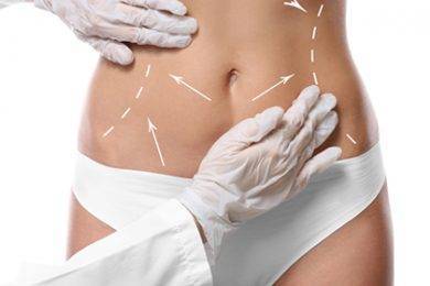 a map-out of a tummy tuck procedure