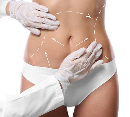 a map-out of a tummy tuck procedure