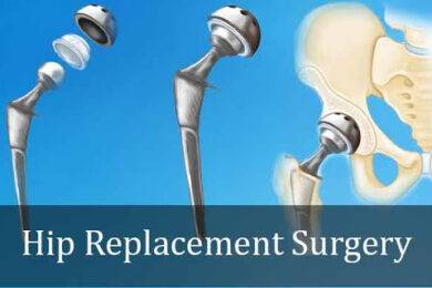 Hip Replacement Surgery