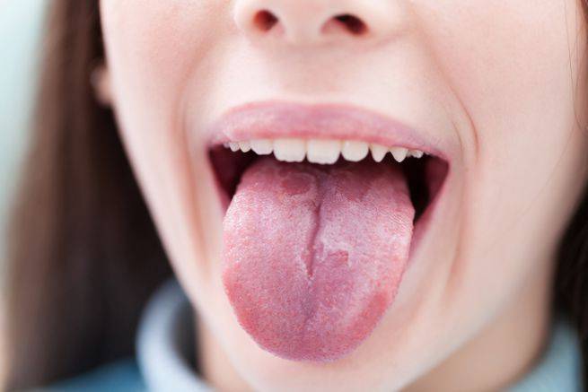 Burning mouth syndrome