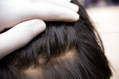 HOW TO GET RID OF HEAD LICE?