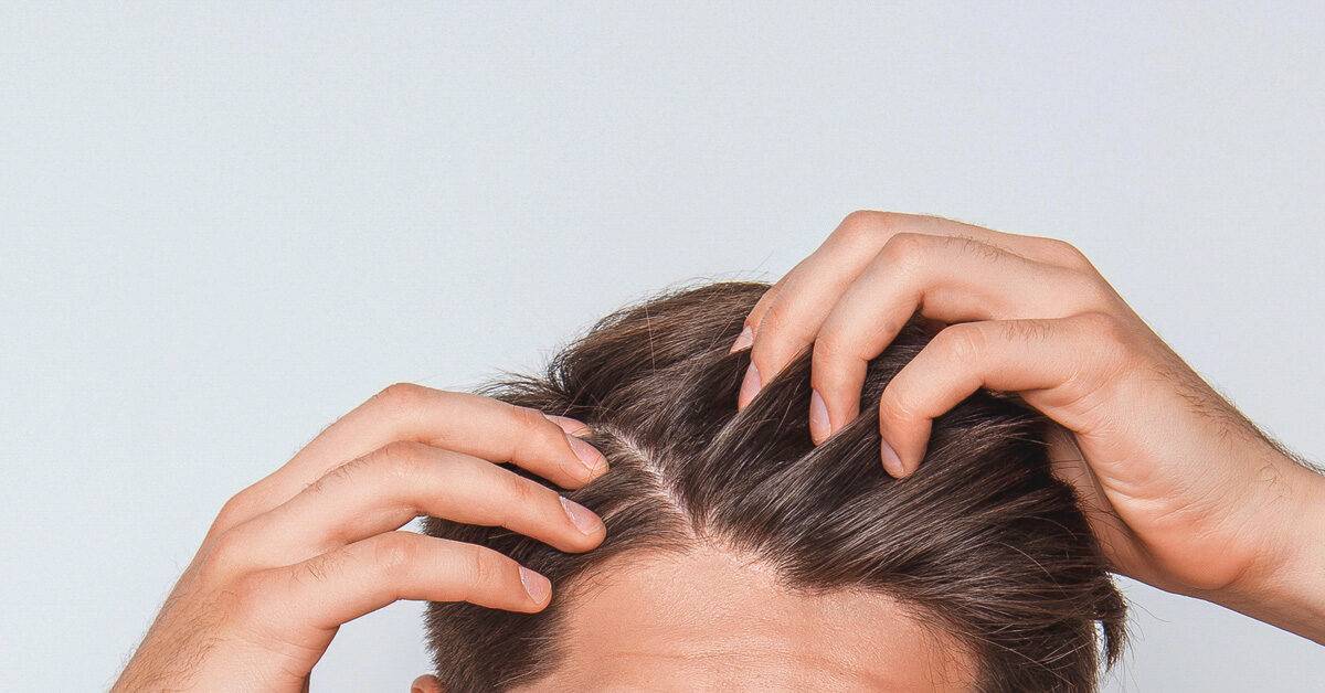 How to Treat Scabs on the Scalp