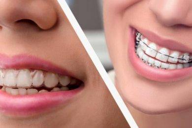 Thinking About Getting Invisalign? You Must Read This First