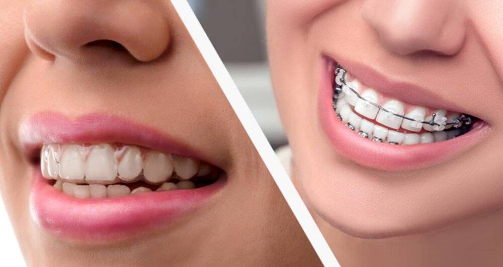 Thinking About Getting Invisalign? You Must Read This First