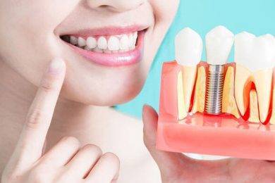 7 Signs You Need Dental Implants