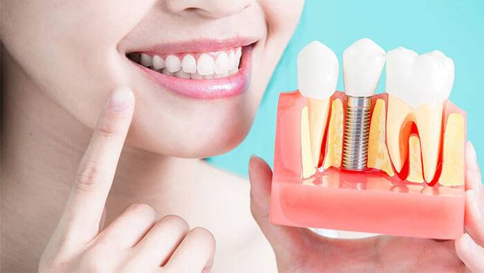 7 Signs You Need Dental Implants
