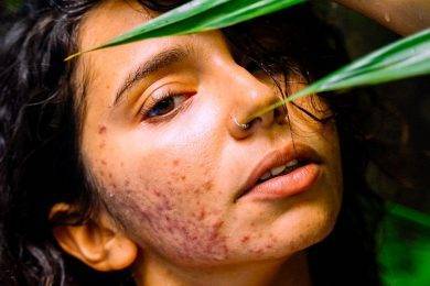 Effectively Treat Cystic Acne