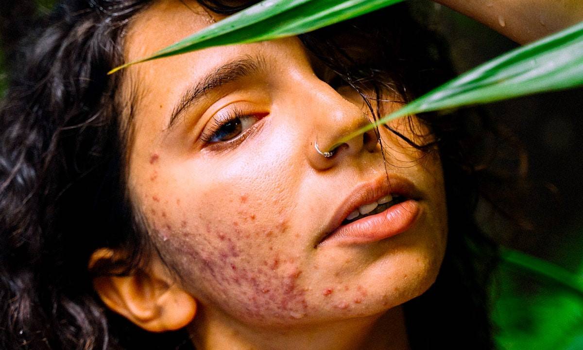 Effectively Treat Cystic Acne